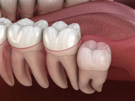 4 Types of Wisdom Teeth Impactions - Laurich Dentistry