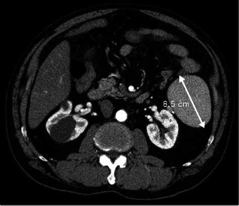 CT scan showing 8.5 cm sized accessory spleen in the left upper quadrant. | Download Scientific ...