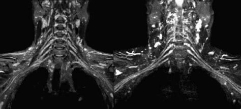 Mri Blog Brachial Plexus Mri Iii