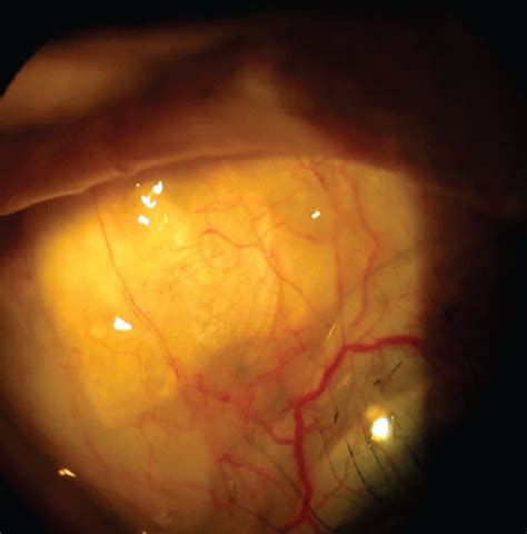 Scleral Lens Fitting Essentials