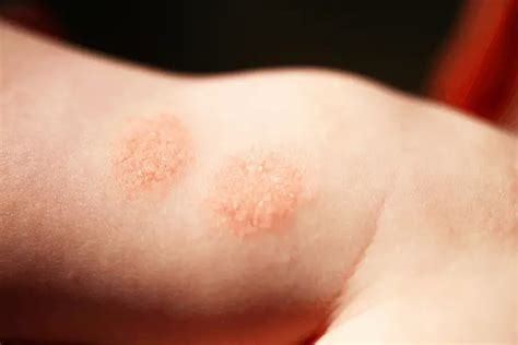 9 Early Signs Of Baby Eczema, You Shouldn’t Avoid!