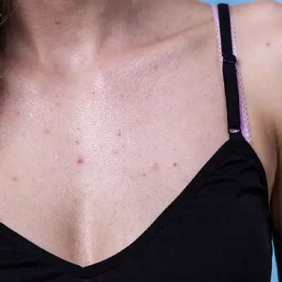 Chest Acne - Causes and Ways to Get Rid of It - Laser Skin Care Clinic Dubai