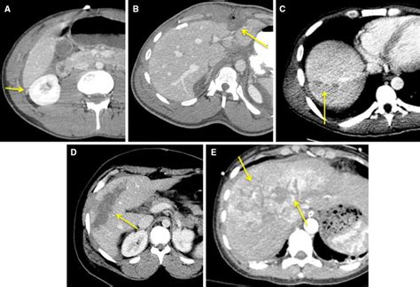 Examples of AAST liver injury grading on CT. A A 17-year-old male with... | Download Scientific ...