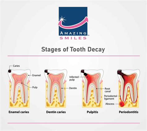 Stages Of Tooth Decay - Tooth Caries - Amazing Smiles