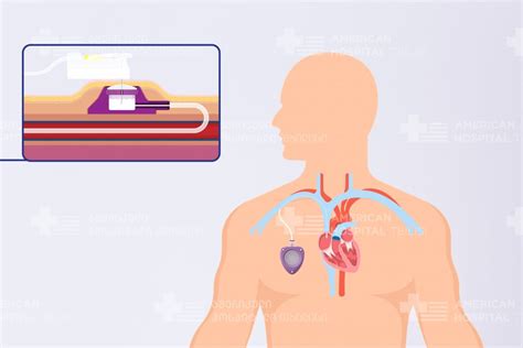 #AHT: What is the Central Infusion (Chemo) Port? - American Hospital Tbilisi