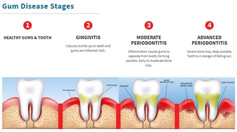 Understanding the Stages of Gum Disease