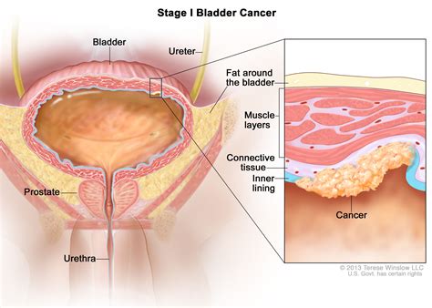 Bladder Cancer Stages - NCI