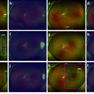 Examples of peripheral retinal lesions located by YOLOX. a Retinal... | Download Scientific Diagram