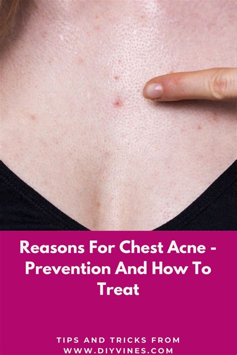 Reasons For Chest Acne - Prevention And How To Treat | Chest acne, Bad acne, Natural acne skin care