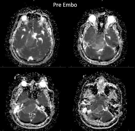 Case Archives Petroclival Meningioma MHT and ILT access | neuroangio.org