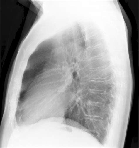 Normal Chest X Ray Lateral View