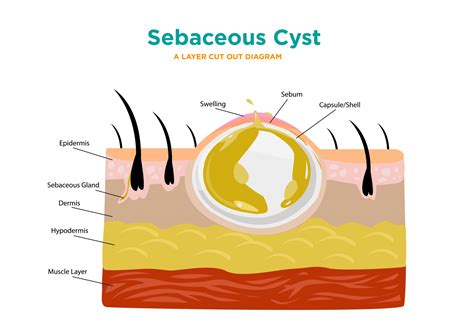 Sebacous Cyst Removal Treatment Available at Excellence Medical