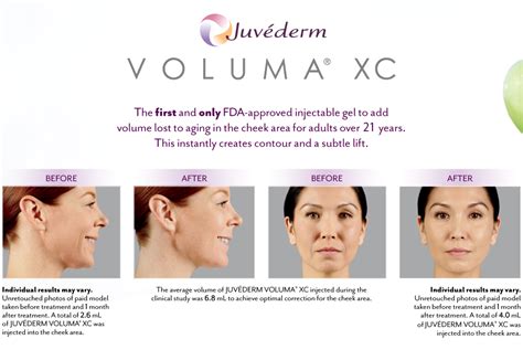 Voluma – Skyngenuity Medical Spa