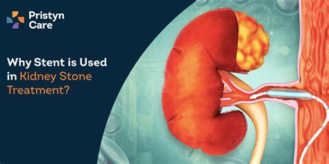 Why Stent is Used in Kidney Stone Treatment? - Pristyn Care