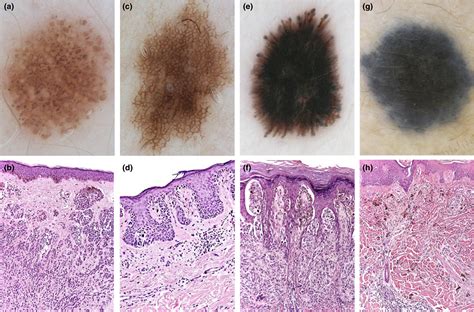 Junctional Nevus