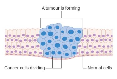 Difference Between Tumor and Neoplasm | Definition, Causes, General Symptoms, Diagnosis