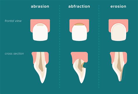 Tooth Erosion Symptoms