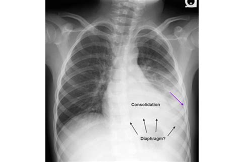 Pneumonia and back pain, interesting Osteopathic case! - City Osteopathy