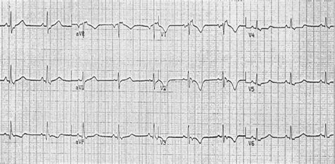 Arrhythmogenic right ventricular dysplasia ECG - wikidoc