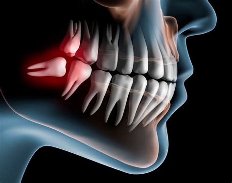 Causes of Wisdom Teeth Pain | Dental Care of Chino Hills - Blog