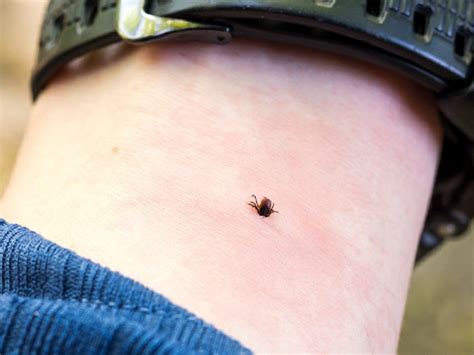 Tick Bites: Symptoms, Treatments, Pictures, and Prevention