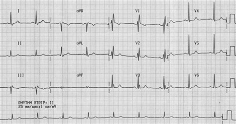 Right Bundle Branch Block (RBBB) • LITFL • ECG Library Diagnosis