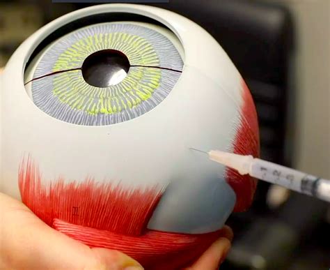 Eye Injections 101 » New York Eye Cancer Center