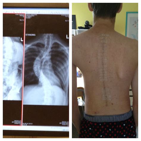 my scoliosis surgery before/after pic : r/WTF