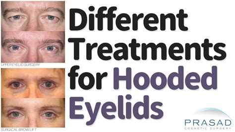 Botox Before And After Hooded Eyes | Before And After