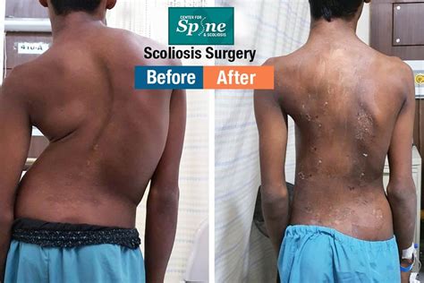 Best Spine Scoliosis correction surgery specialist in India