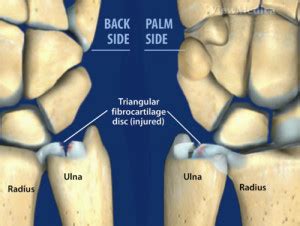 Cartilage and Ligament Tears of the Wrist | The Hand and Wrist Institute (2023)