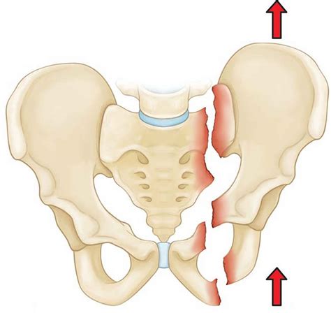 Pelvic fracture types, causes, signs, symptoms, diagnosis & treatment