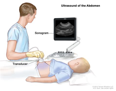 Neuroblastoma Treatment - NCI