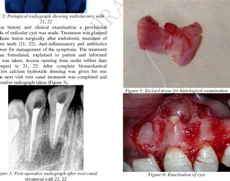 Figure 2 from Surgical Management Of Radicular Cyst With Microscope – A Case Report | Semantic ...