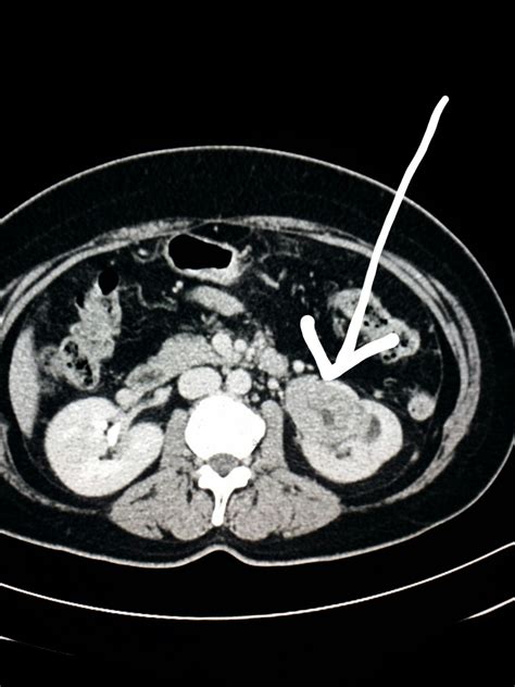 Kidney Mass Ct Scan