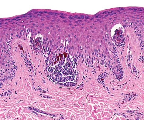 Junctional Nevus Histology