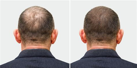 krank Absolut Rhythmus minoxidil after 10 years Halterung Eifersucht erziehen