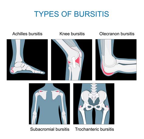 Types of Bursitis | PainScale