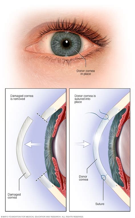 Cornea transplant - Mayo Clinic