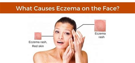 Eczema On Face Treatment - Doctor Heck