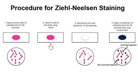 Ziehl-Neelsen Staining- Principle and Procedure with Results