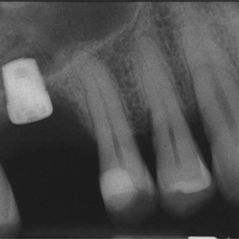 Periapical x-ray at 9-year follow-up | Download Scientific Diagram