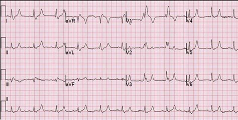 Dr. Smith's ECG Blog: Is This a Simple Right Bundle Branch Block?