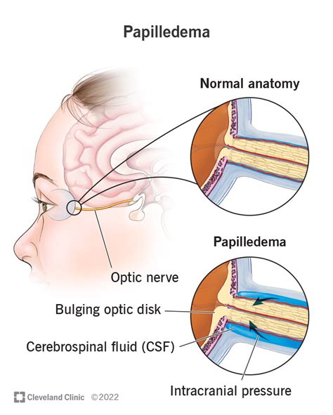 Optic Nerve