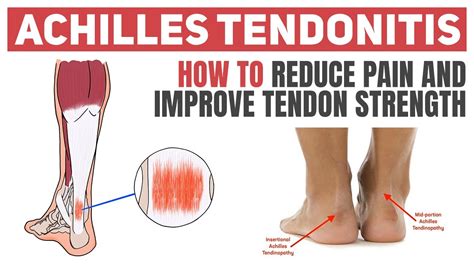 Achilles Tendonitis Exercises Worksheet | ubicaciondepersonas.cdmx.gob.mx