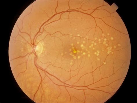 Macula Degeneration - Westmead Eyes Optometrists