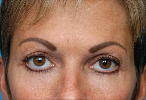 Dry Eye Symptoms and Chemosis Following BlepharoplastyA 10-Year Retrospective Review of 892 ...