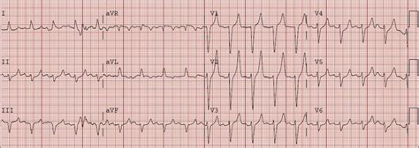 Dr. Smith's ECG Blog: HyperKalemia with Cardiac Arrest. Peaked T waves: Hyperacute (STEMI) vs ...