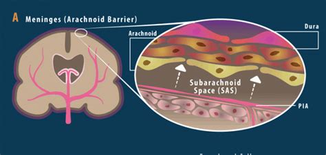 Arachnoid Cyst Symptoms - HRF