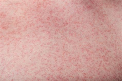 Dengue rashes: Appearance, Symptoms and Meaning | General Medicine